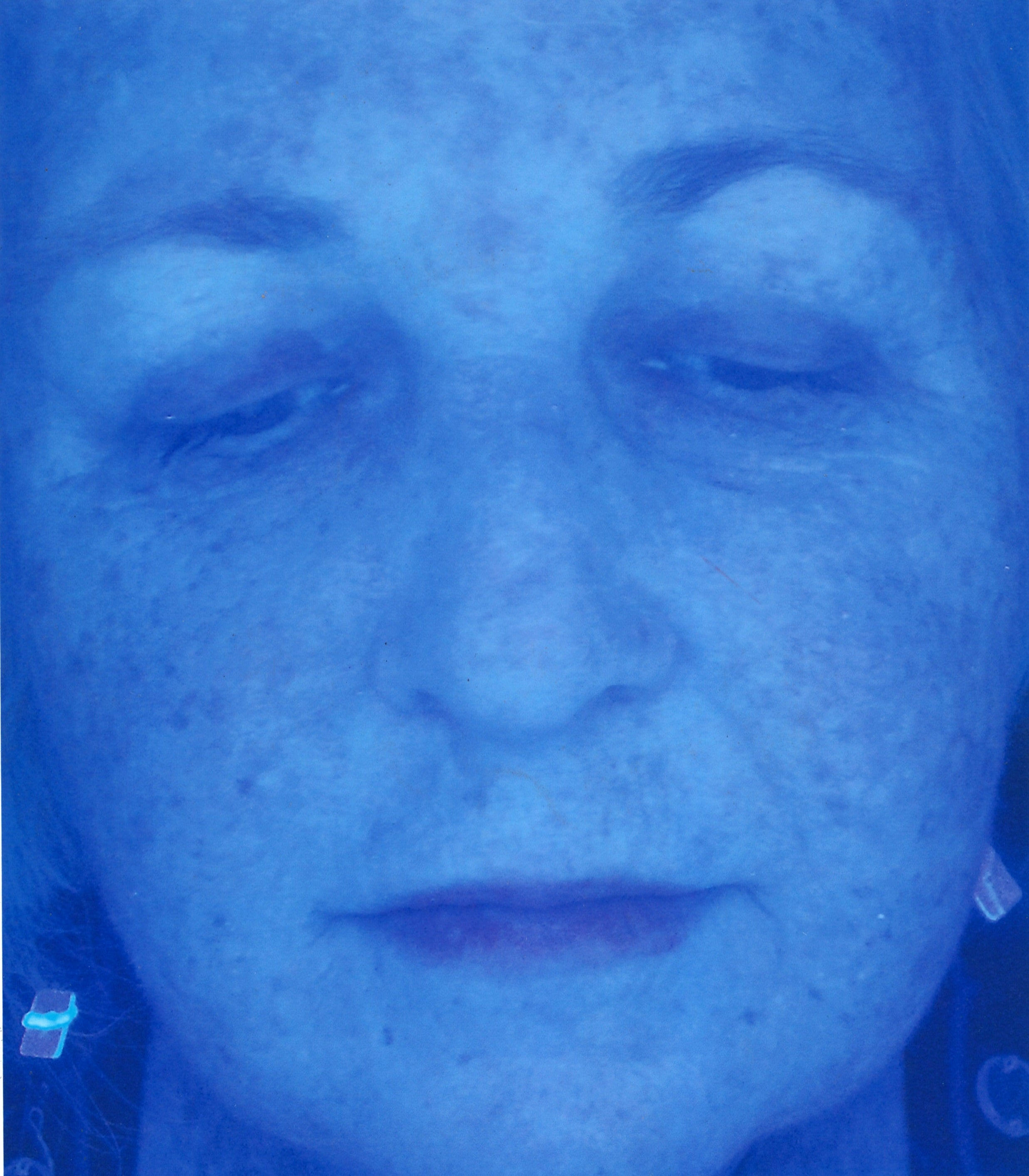 Ultraviolet light image showing the appearance of sun damage has improved after using Photolagen-AGF for 60 days.  