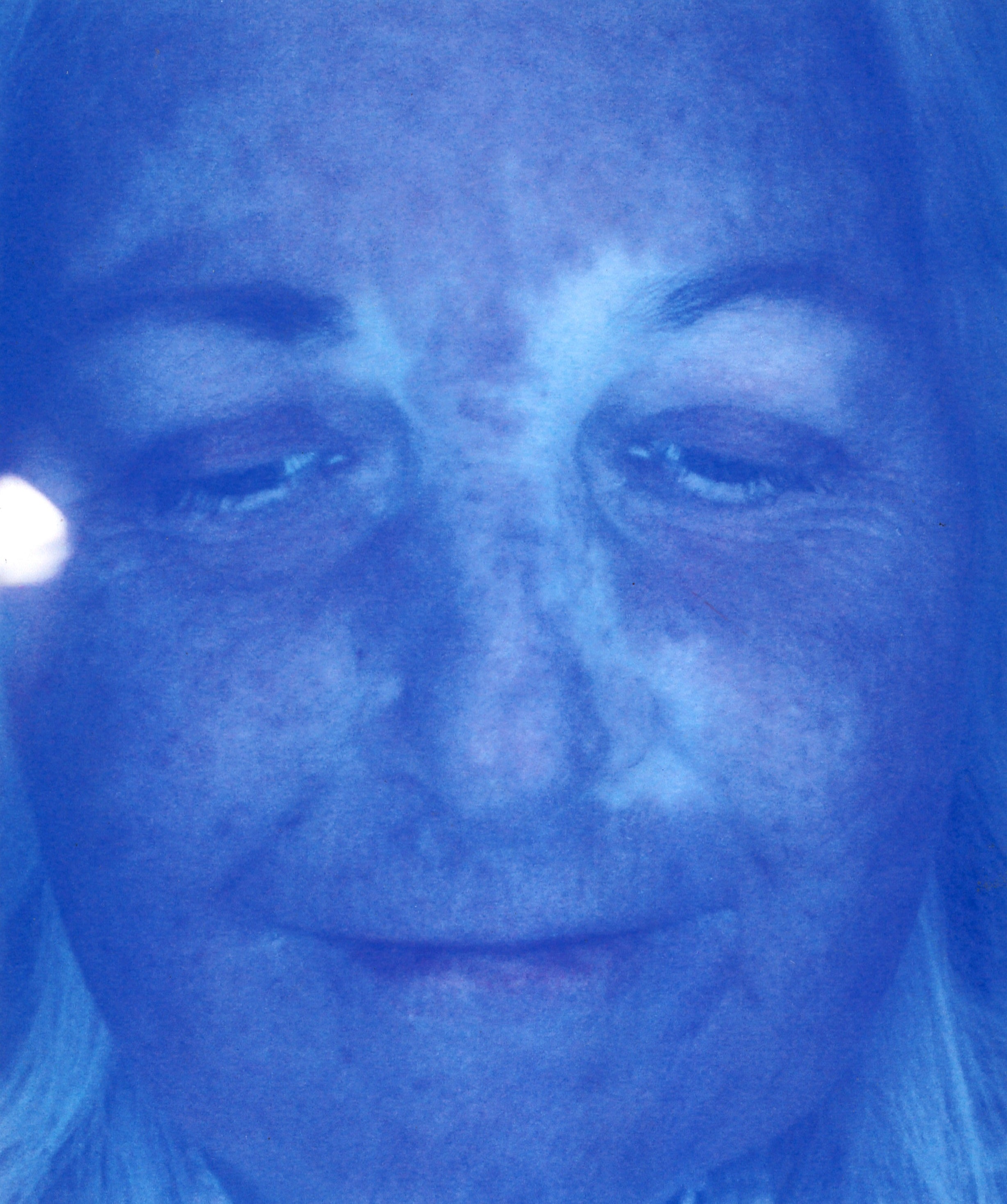 Ultraviolet light image showing where the appearance of sun damage is that is not yet visually seen by the eyes.