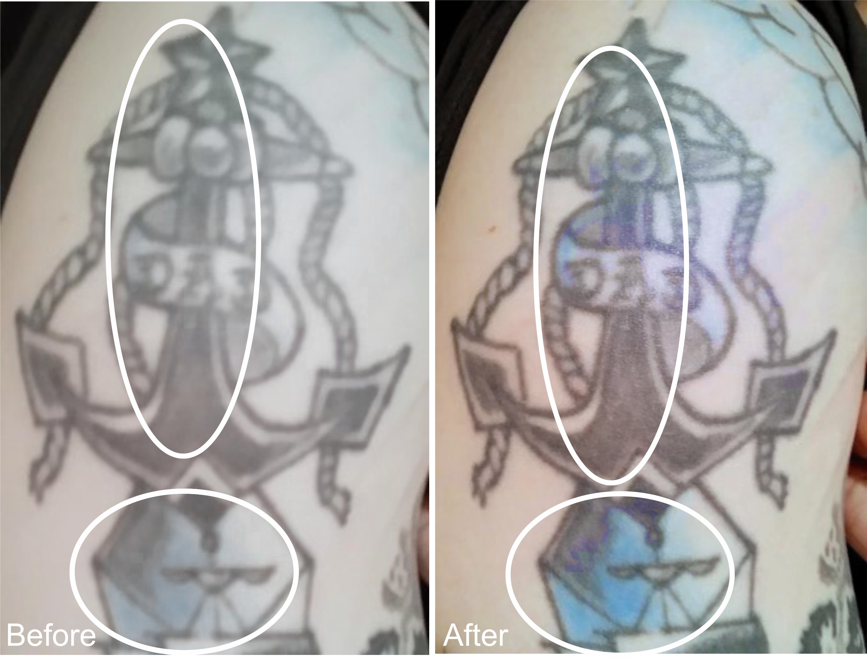 Anchor Tattoo Before and After