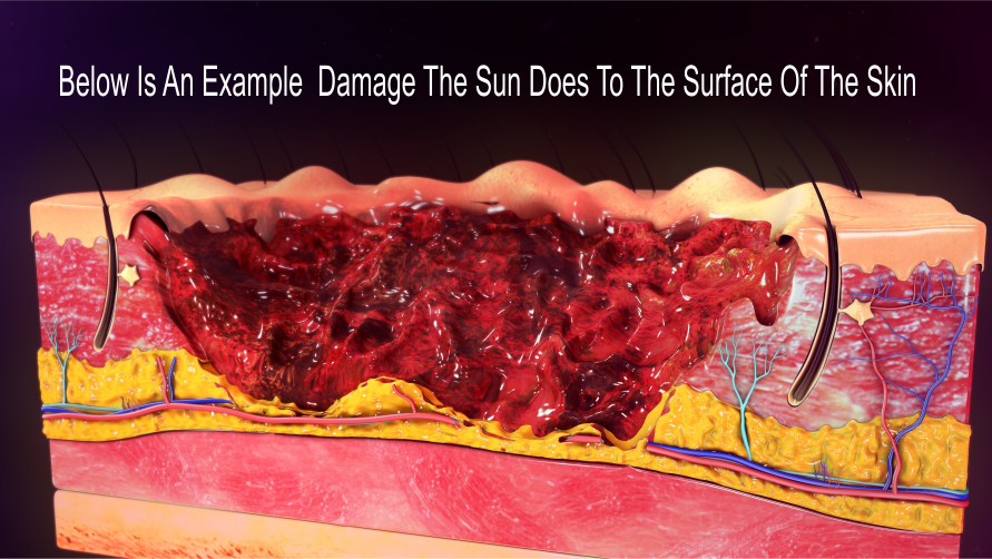 Illustration showing the appearance of cumulative sun damage which now shows on the skin's surface. 