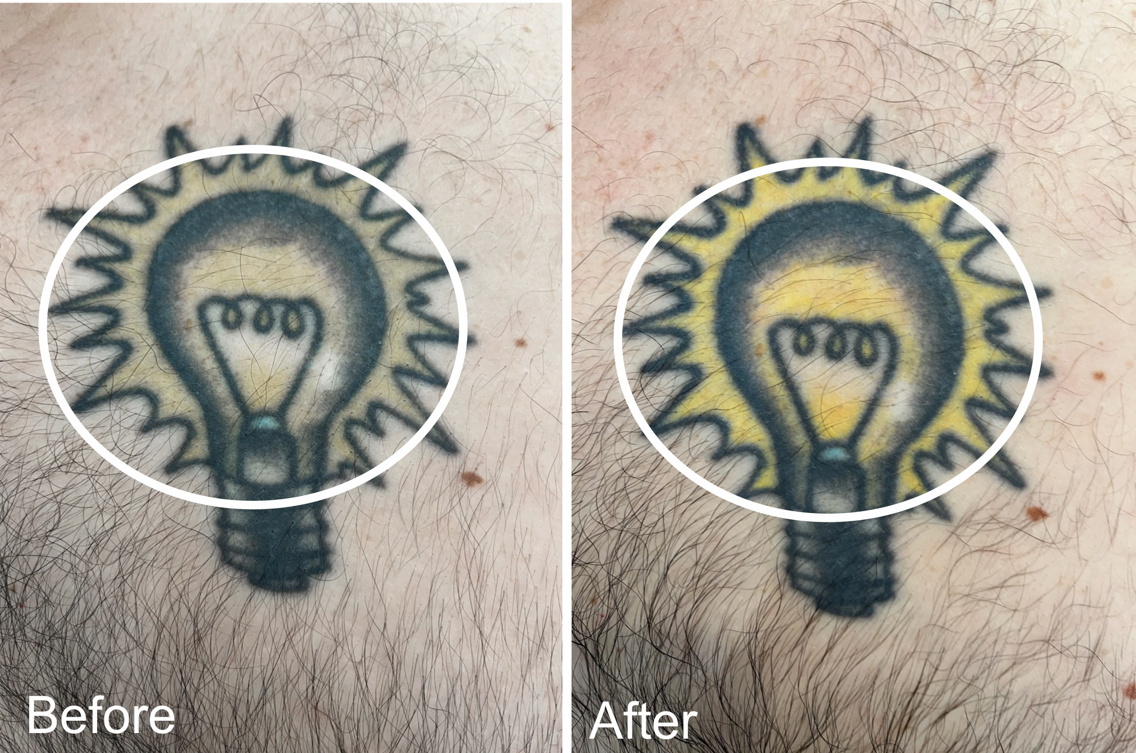 Light bulb Tattoo Before and After