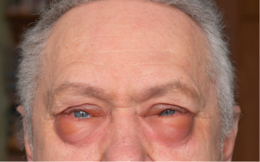 Image of a man showing tired, puffy, discolored under eye area caused by sun damage.