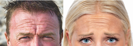 Image of a man and woman showing deep forehead wrinkles and furrows.