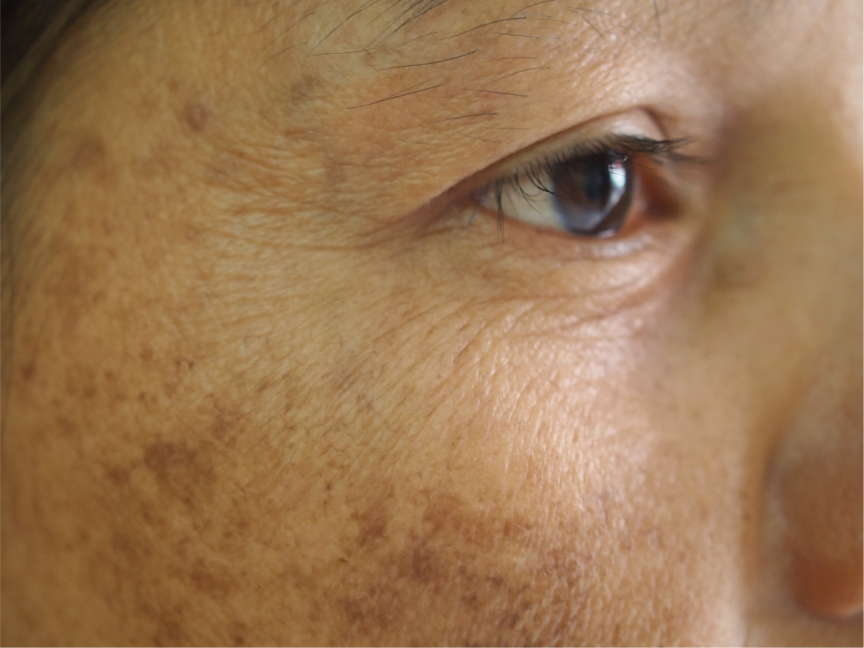 Image Of Typical Facial Sun Damage Showing Discoloration Spots Associated With Sun Damage.