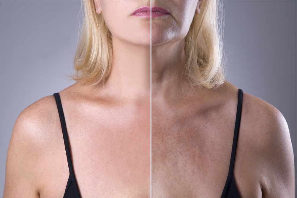 Image showing sun damage is not limited to just facial areas, showing it affects the appearance of the neck and chest areas.