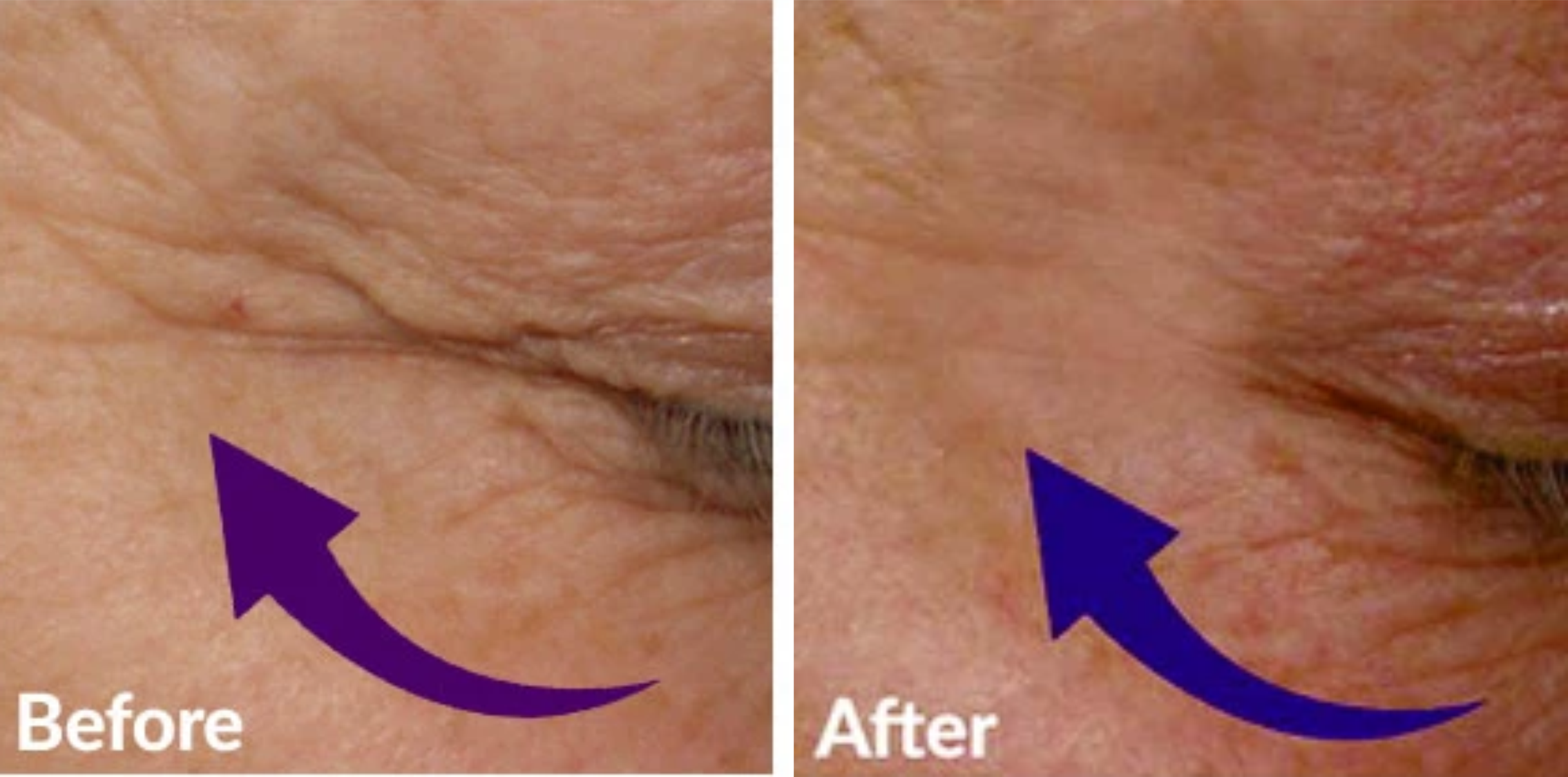 Before and After Crows feet Image