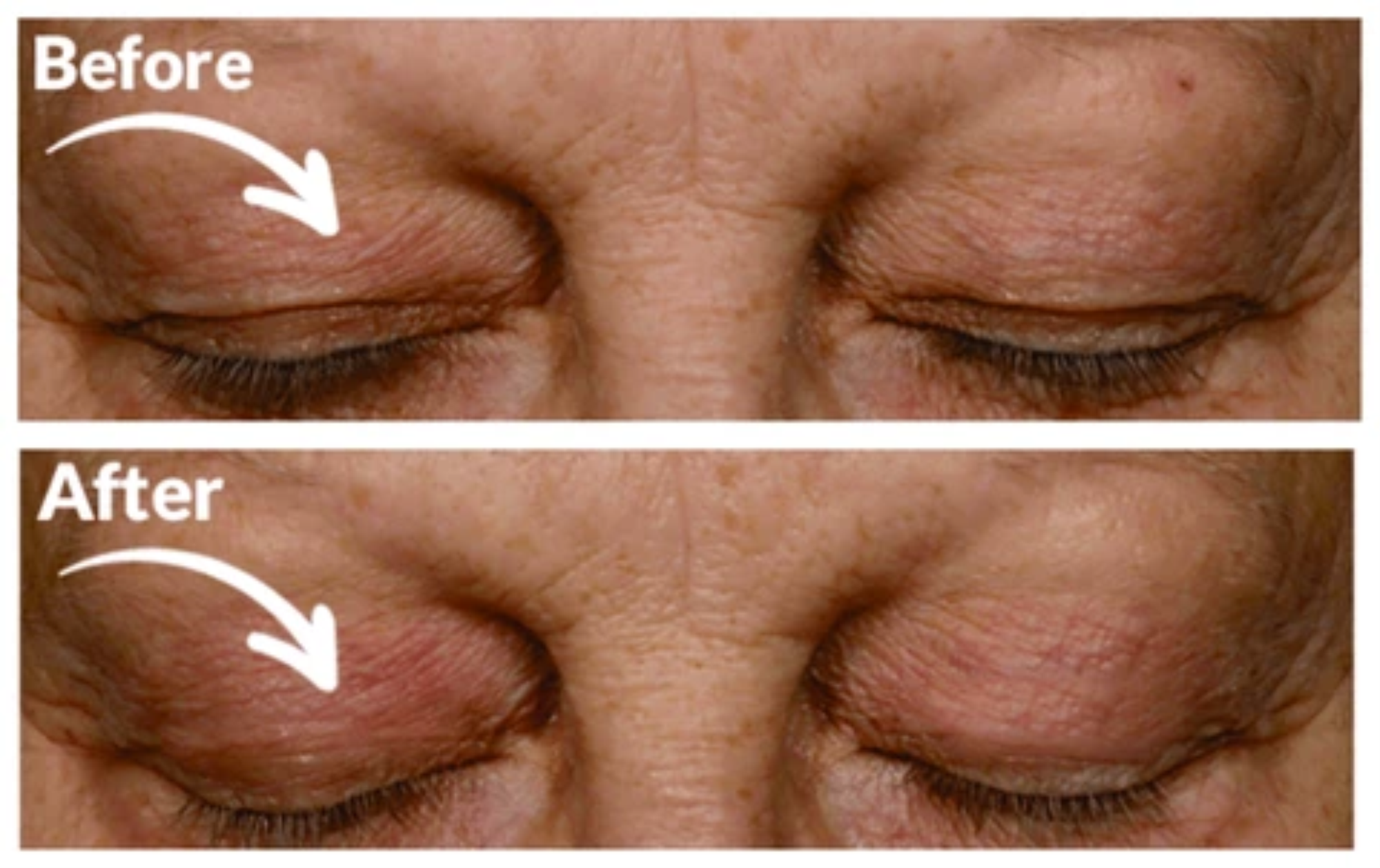 Front View Before and After Eyelids Image