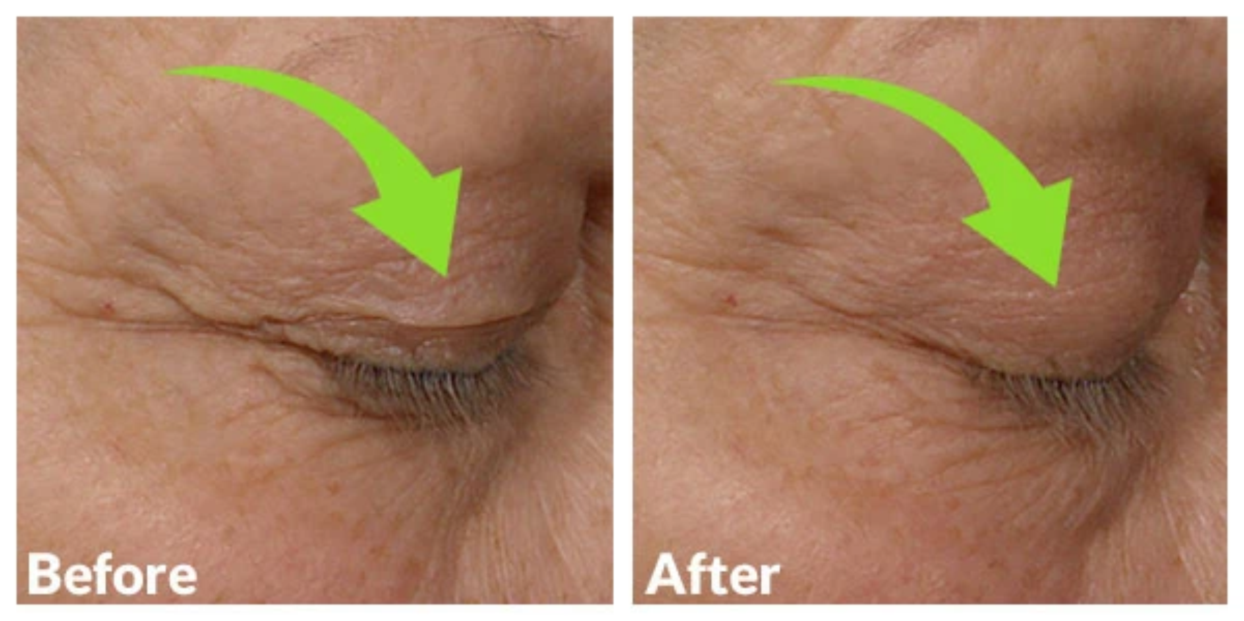 Before and After Eyelids Image Side View