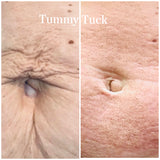 Fibroblast Tummy tuck