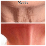 Fibroblast Neck Lift