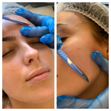 Dermaplaning