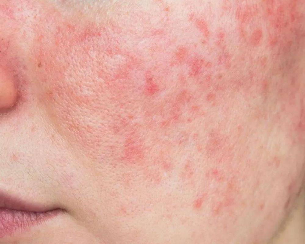 rosacea cheeks treatment