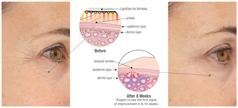 lightstim for wrinkles