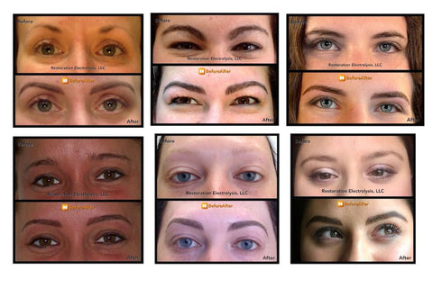 Restoration Electrolysis Eyebrow Makeover Before and After