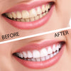 Professional Teeth Whitening Home Kit - Homemark