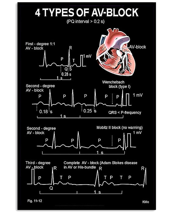 Ecg Heart Four Types Of Av-Block Cardiologist Vertical Canvas And Poster | Wall Decor Visual Art