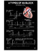 Ecg Heart Four Types Of Av-Block Cardiologist Vertical Canvas And Poster | Wall Decor Visual Art