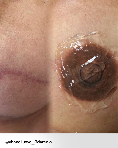 Masectomy Areola Reconstruction Before and After