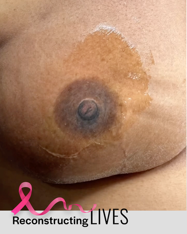 Breast Cancer Survivor Areola Reconstruction