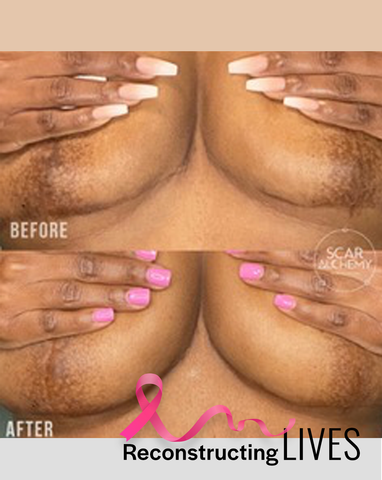 Breast scar camouflage before and after
