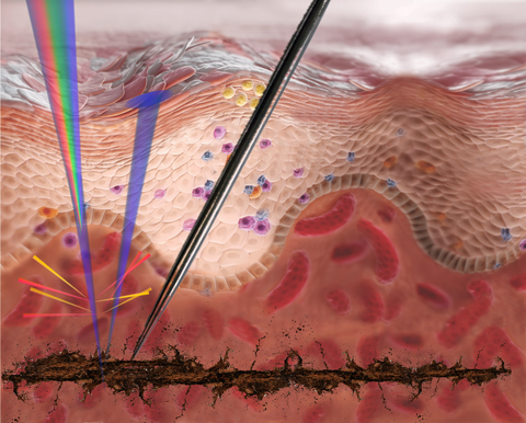 Diagram of deep insertion of black pigment in facial skin, copyrights by Anna Ocko Pezina