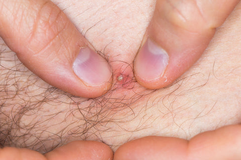 Popping Ingrown Hair