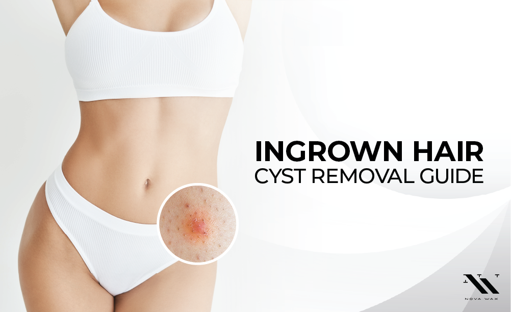 How to Remove Ingrown Hair Cysts