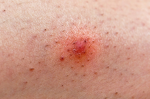 Are Bleeding and Bumps After Waxing Normal? - Nova Wax