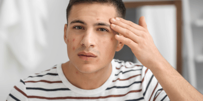 Young man with acne