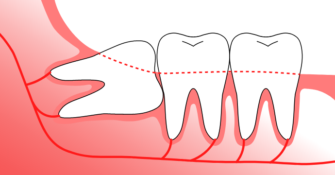 Everything You Need To Know About Wisdom Teeth Dr Samuel Fairywill