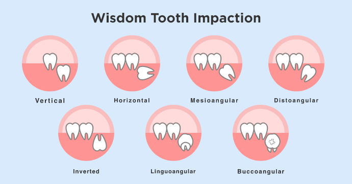 wisdom teeth impaction