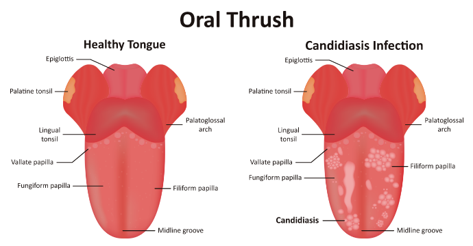 Oral thrush