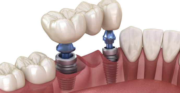 dental implants