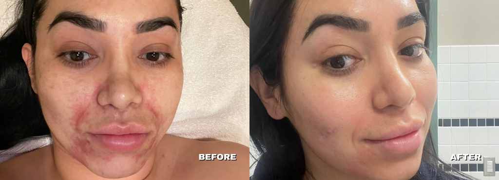 Before & after Microneedling