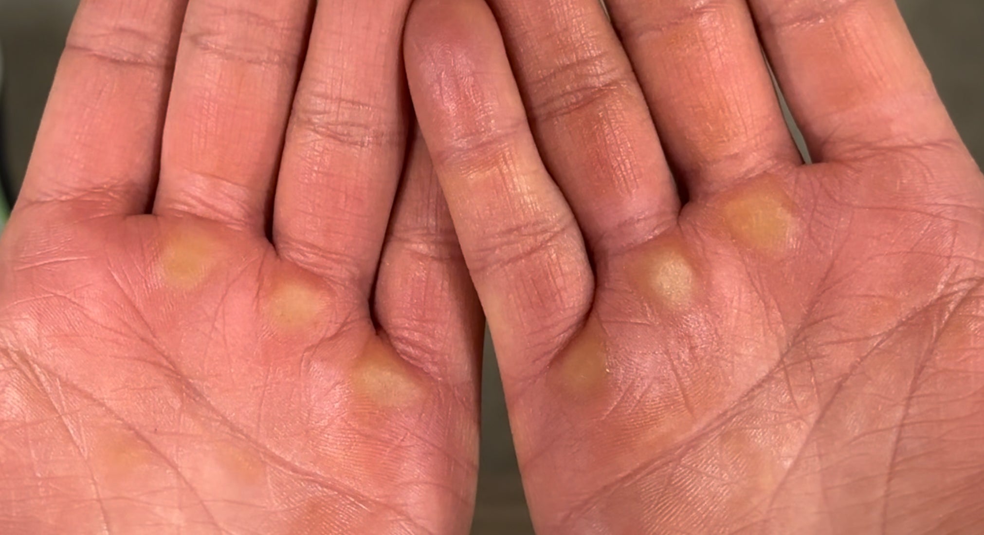 Two hands showing the smoothness of their calluses after using the SandBar Callus File and SandBar Salve.