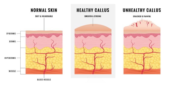 Display of normal skin, healthy calluses, and unhealthy calluse