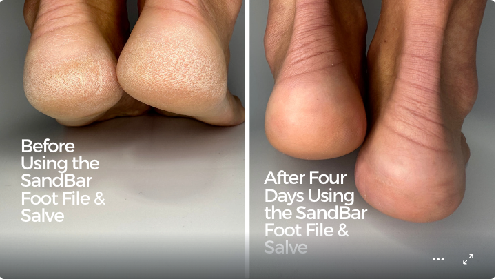 Photos of heels before and after the SandBar Salve and Foot File are used