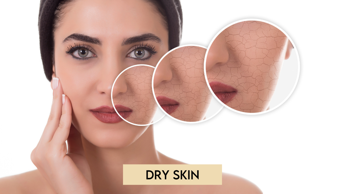 DRY_SKIN