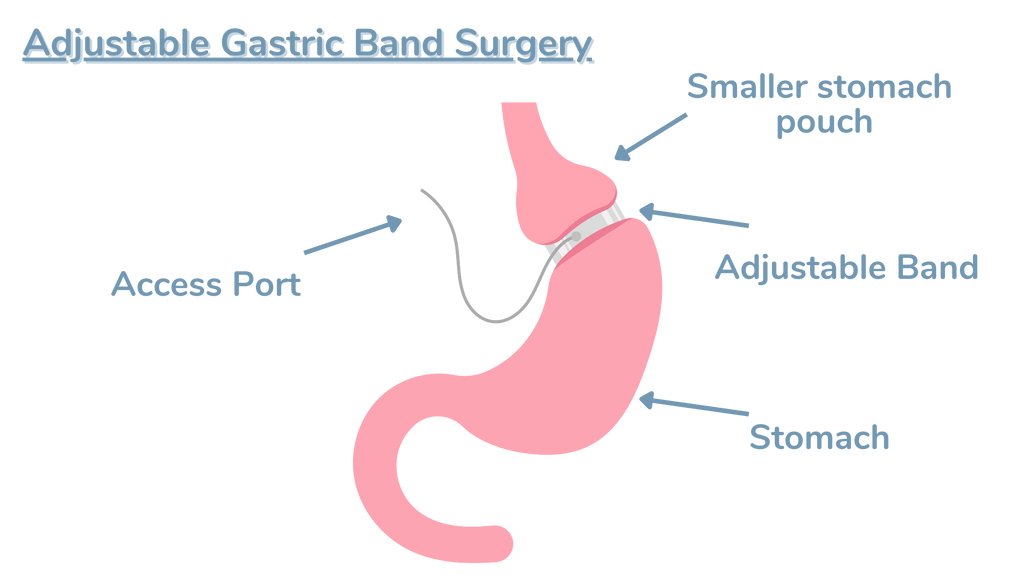 Types of Bariatric Surgery - Gastric Band Surgery