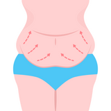 tummy tuck after bariatric surgery