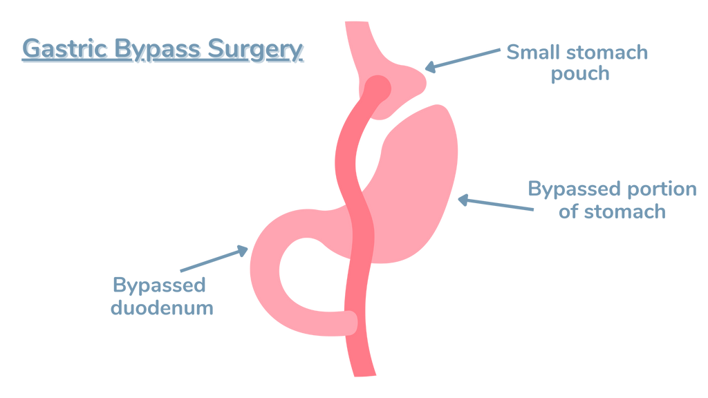 Types of Bariatric Surgery - Gastric Bypass
