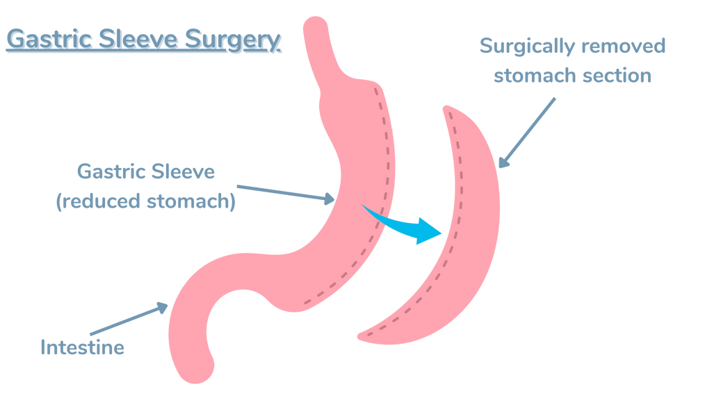 types of bariatric surgery - gastric sleeve