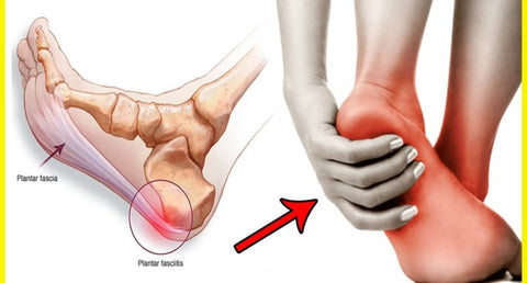 ALLEVIATE !) Plantar Fasciitis Pain 