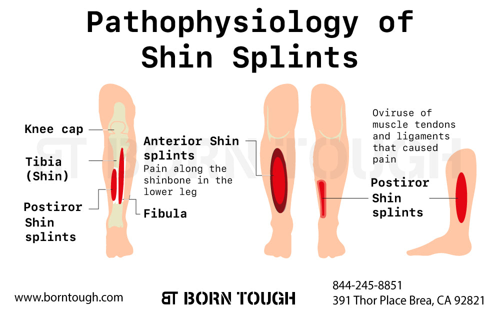 Anatomy of Shin Splints