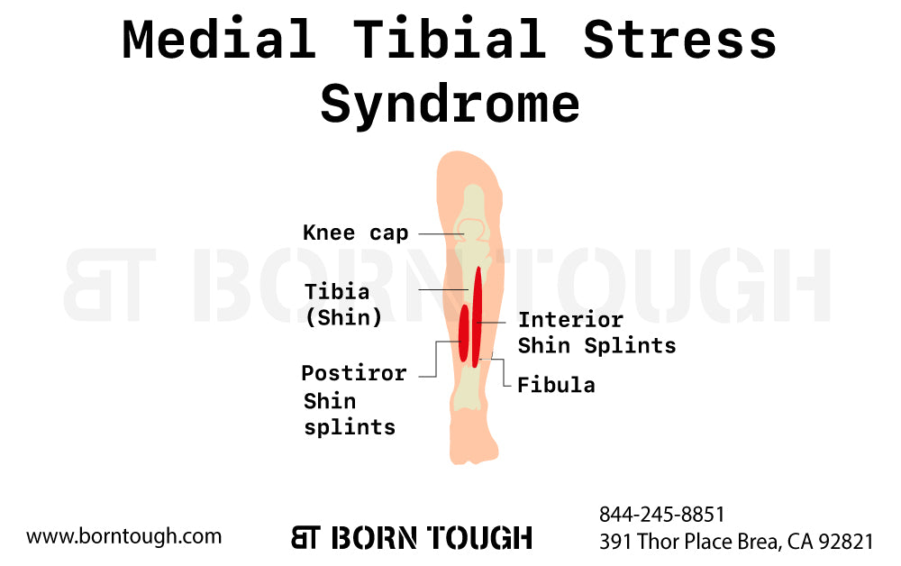 Shin Splints – Medial Tibial Stress