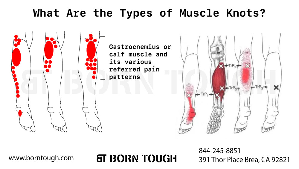 Muscle Knots in Calf