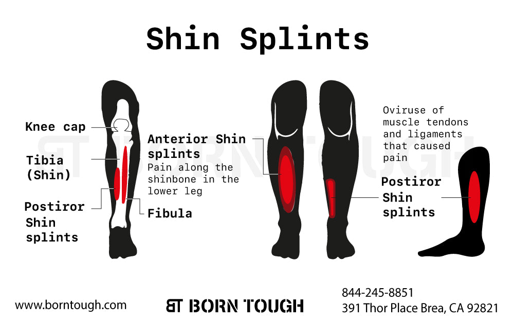 What are Shin Splints?