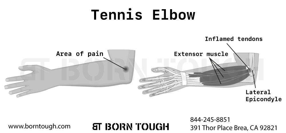 What is Tennis Elbow?