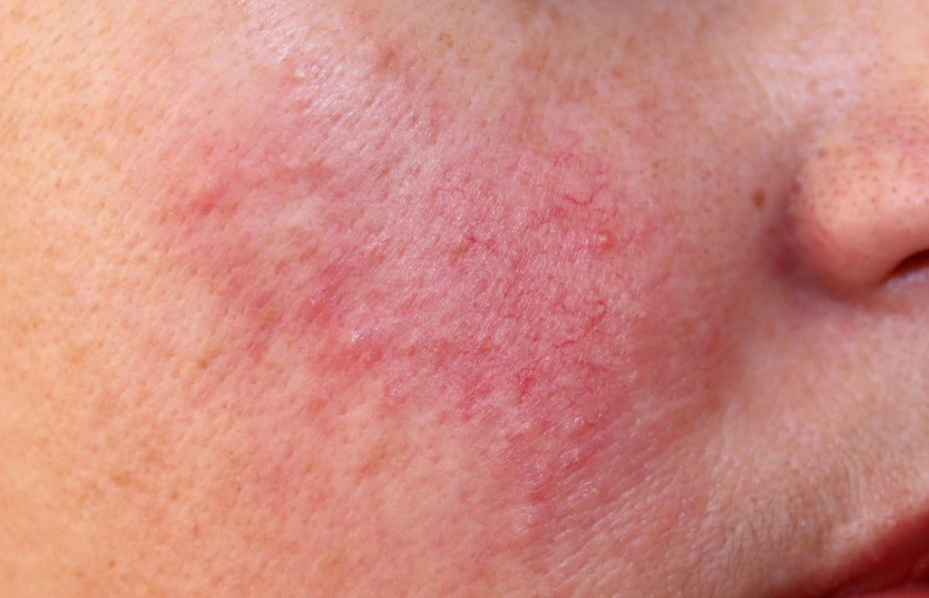 Soothing Rosacea