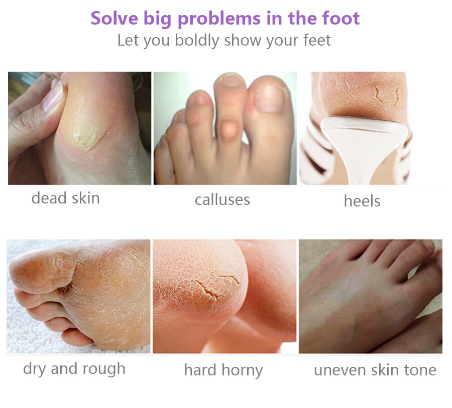 foot scrub for dead skin